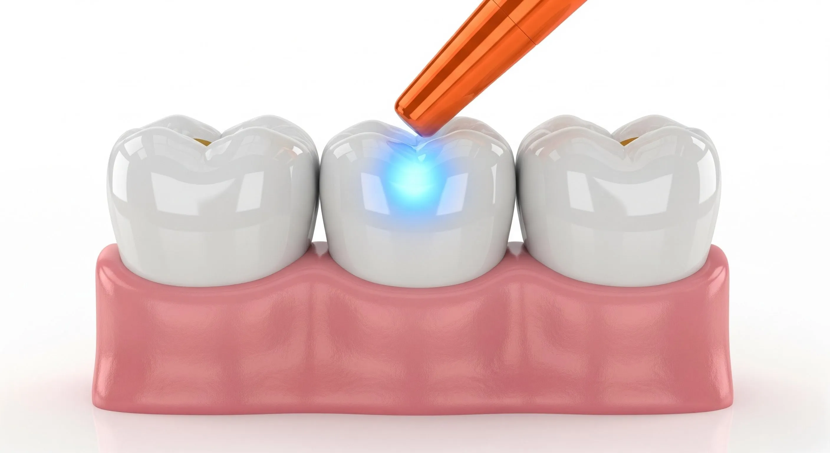 Composite Fillings Cost and Pricing Information in Cayce
