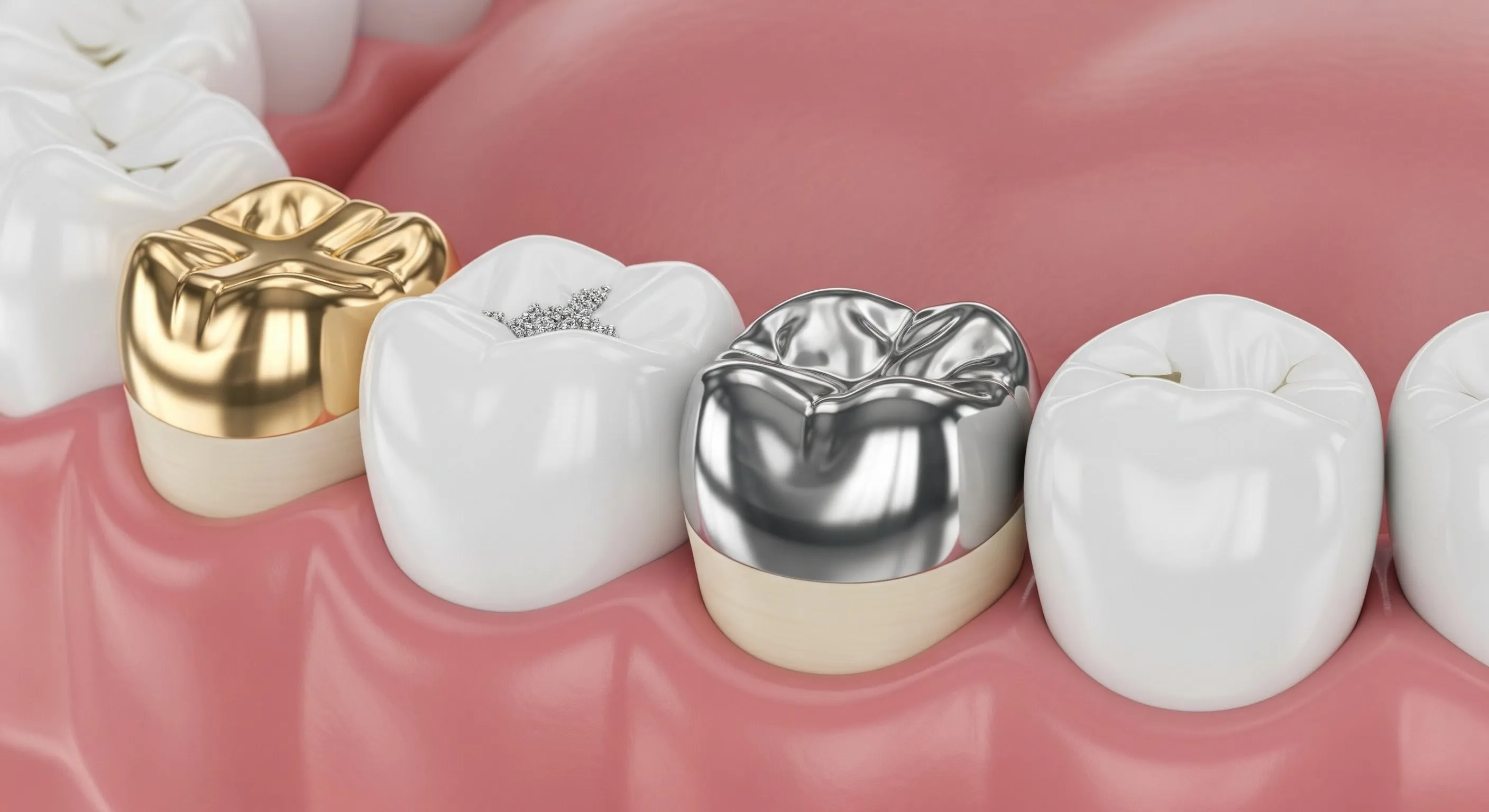 Types of Dental Fillings