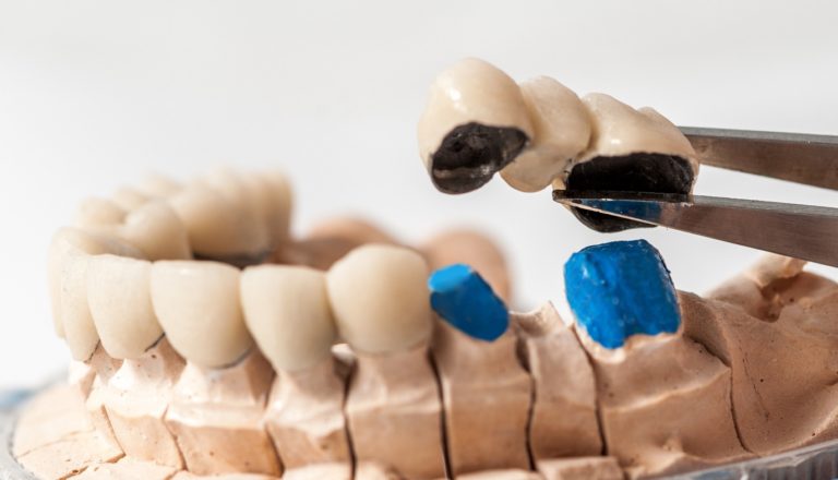 Prosthodontics - Todays Dental Cayce