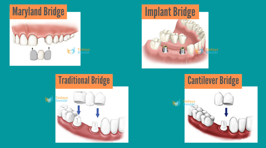   Todays Dental - Dental Bridges