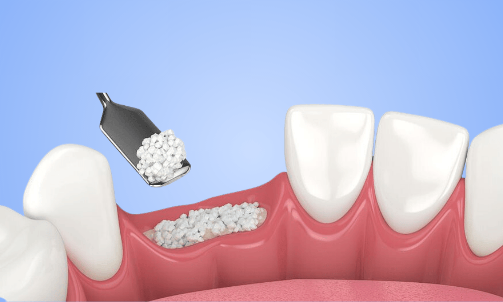 Why Choose Bone Grafting in Cayce?