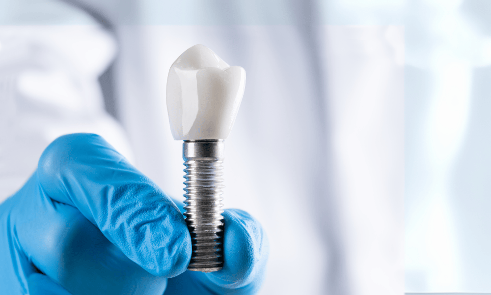 Why Choose Todays Dental Cayce for Dental Implants?