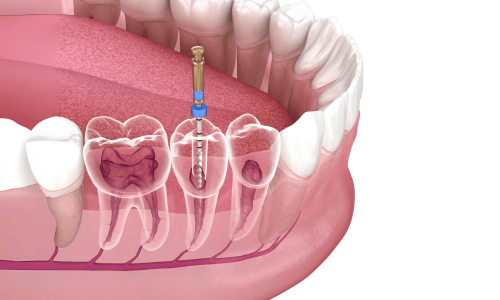 Understanding Endodontics