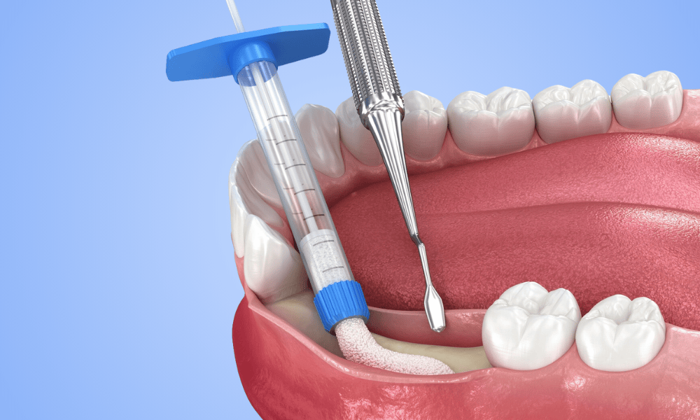 Benefits of Bone Grafting