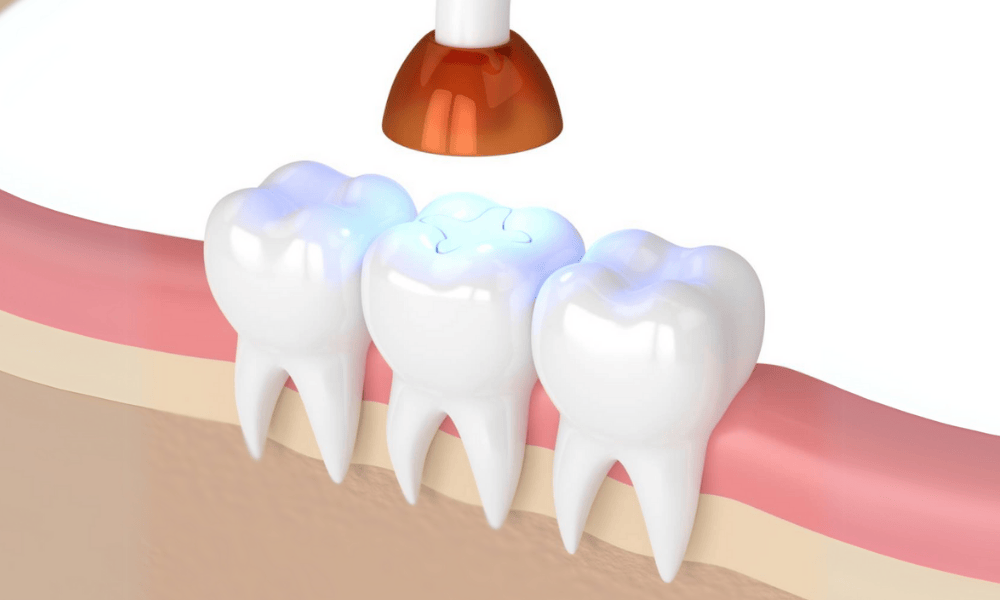 Composite Fillings Cost and Pricing Information in Cayce